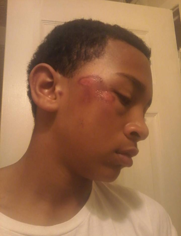 This 13-year-old student at Camelot Academy in Pensacola, Florida, says his face was bruised when a staff member knocked him to the ground. Camelot says it was an accident. (Courtesy of Pauline Ball)