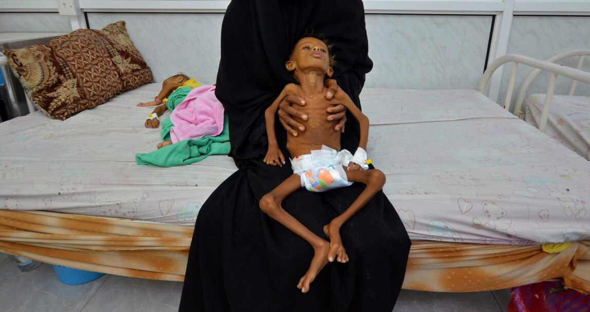 A six-year-old boy is held by his mother at a malnutrition intensive care unit at a hospital in Hodaida, Yemen. Reuters